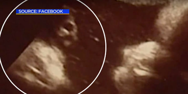 Baby's Sonogram Shows Jesus' Face